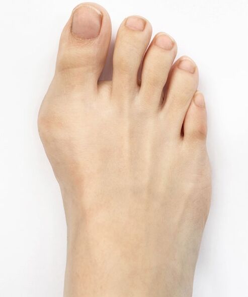 hallux valgus pred uporabo pršila Hondro Sol Valgus