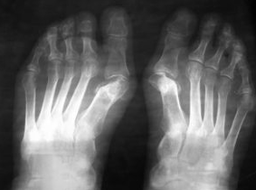 Indikacije za operacije pod Valgus stopala