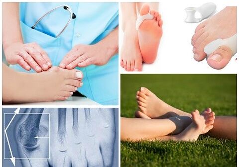 Zdravljenje deformacije Valgus