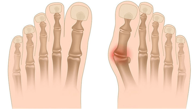 Zdravljenje deformacije Valgus